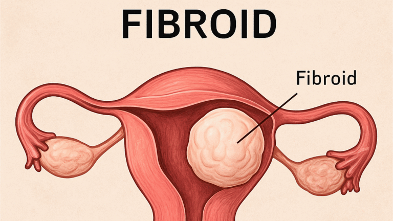 Fibroid